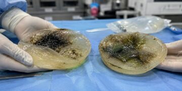 Sumnja na buđ u implantatima za grudi: Lekari upozoravaju na redovne kontrole