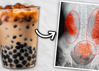 „Bubble Tea“ uništava bubrege: Lekari izvadili devojci više od 300 kamenaca