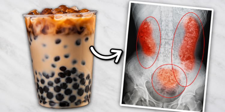 „Bubble Tea“ uništava bubrege: Lekari izvadili devojci više od 300 kamenaca