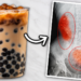 „Bubble Tea“ uništava bubrege: Lekari izvadili devojci više od 300 kamenaca